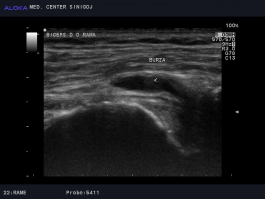 Ultrazvok rame - burzitis bicepsove burze, desna rama burza